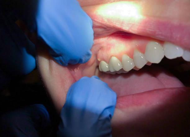 Best Emergency Root Canal Treatment in Dardenne Prairie, MO